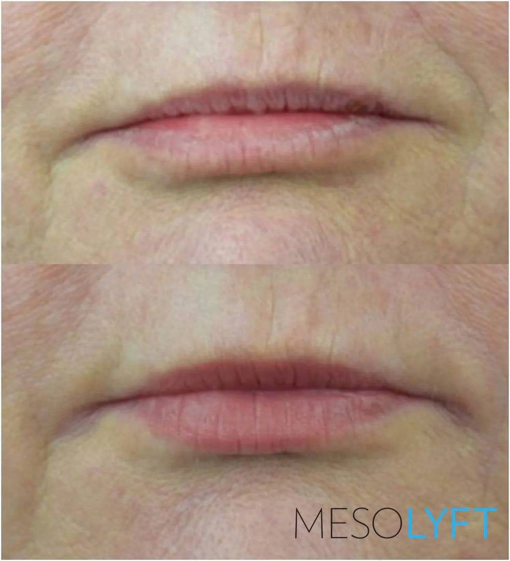 MESOLYFT Plumper LIP -