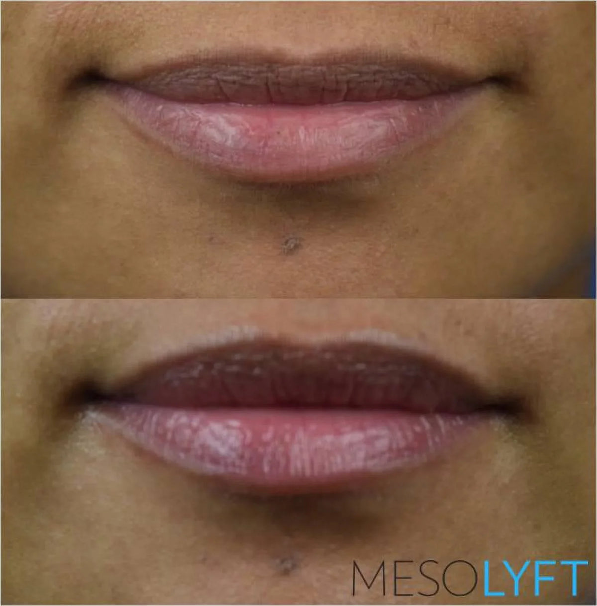 MESOLYFT Plumper LIP -